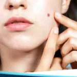 Cara Menghilangkan Jerawat Secara Alami Dan Cepat